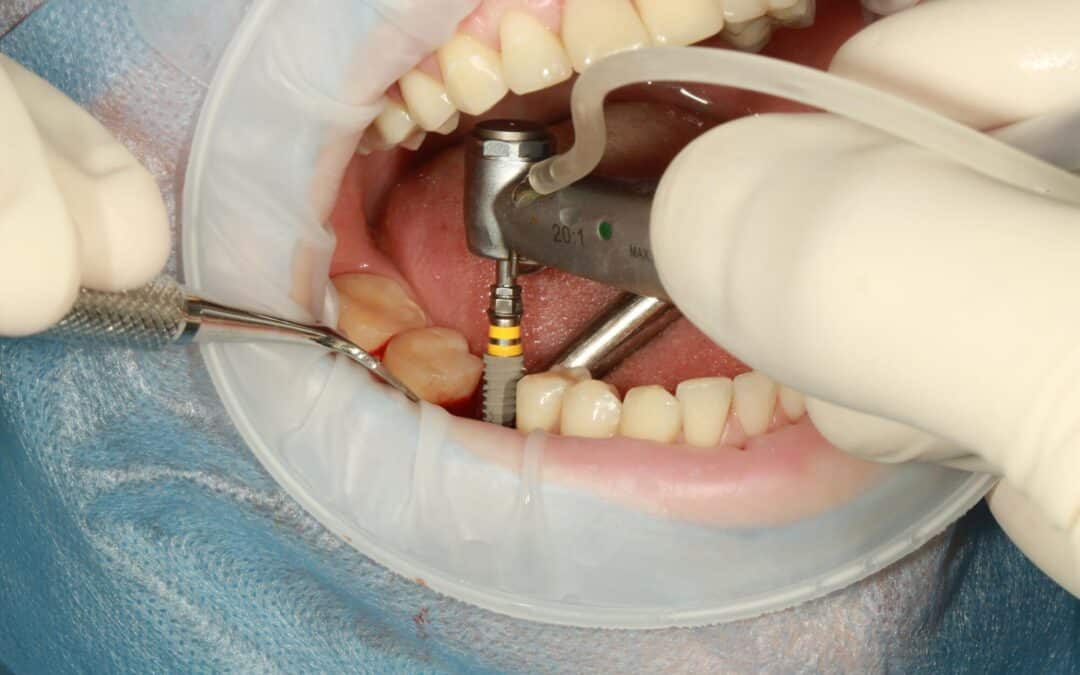 Unlock Your Best Smile with Dental Implants in Sarasota