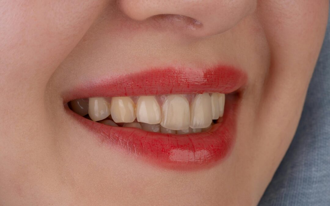 When to Seek Teeth Whitening: Tips From a Venice, FL Dentist